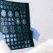 A researcher examines a brain scan with charts and data on Alzheimer’s research displayed.